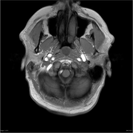 Thornwaldt cyst | Radiology Case | Radiopaedia.org