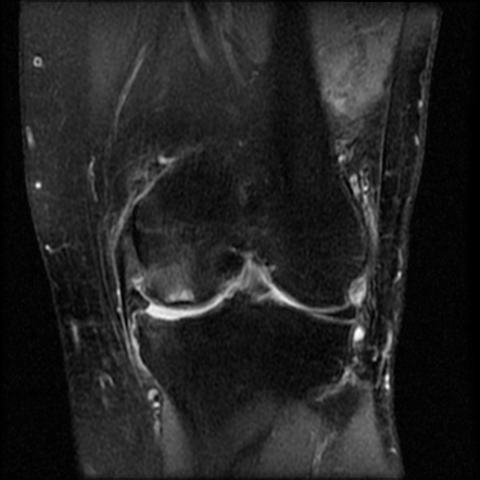 Medial Meniscus Tear 