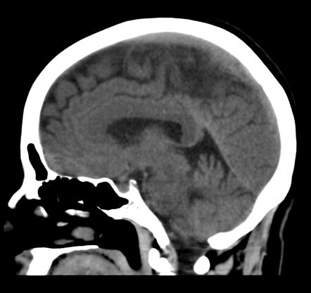 Cavum septum pellucidum and cavum vergae | Image | Radiopaedia.org