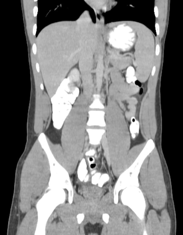 Appendicitis And Incidental Foregut Duplication Cyst Image