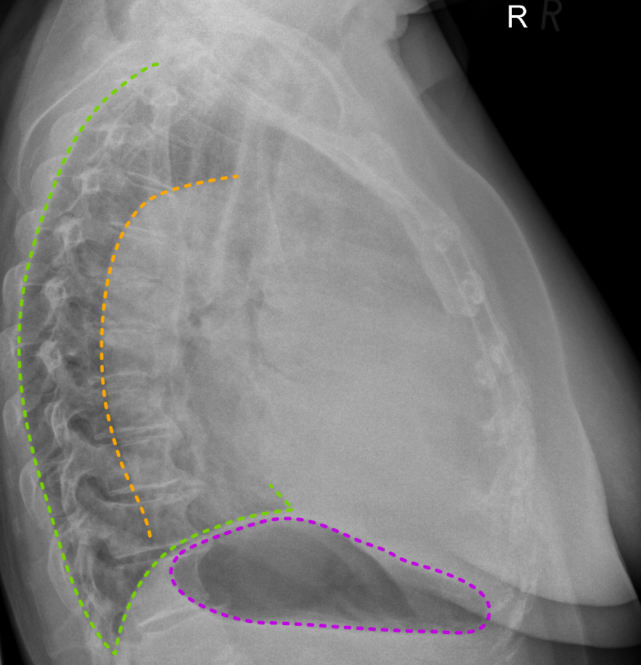 Right hemithorax white-out: pleural effusion | Image | Radiopaedia.org