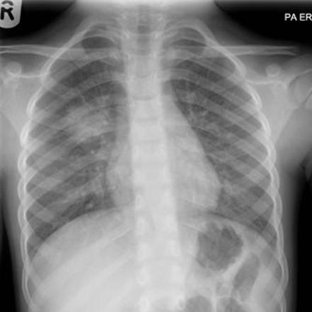 Round pneumonia | Radiology Reference Article | Radiopaedia.org