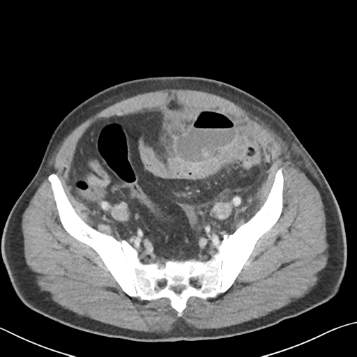 Complicated diverticulitis (pericolic abscess) | Image | Radiopaedia.org