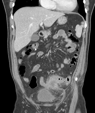 Complicated diverticulitis (pericolic abscess) | Image | Radiopaedia.org