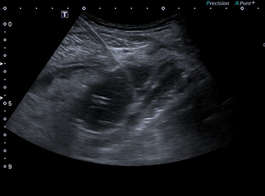 Complicated diverticulitis (pericolic abscess) | Image | Radiopaedia.org