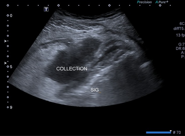 Complicated Diverticulitis Pericolic Abscess Image 1332