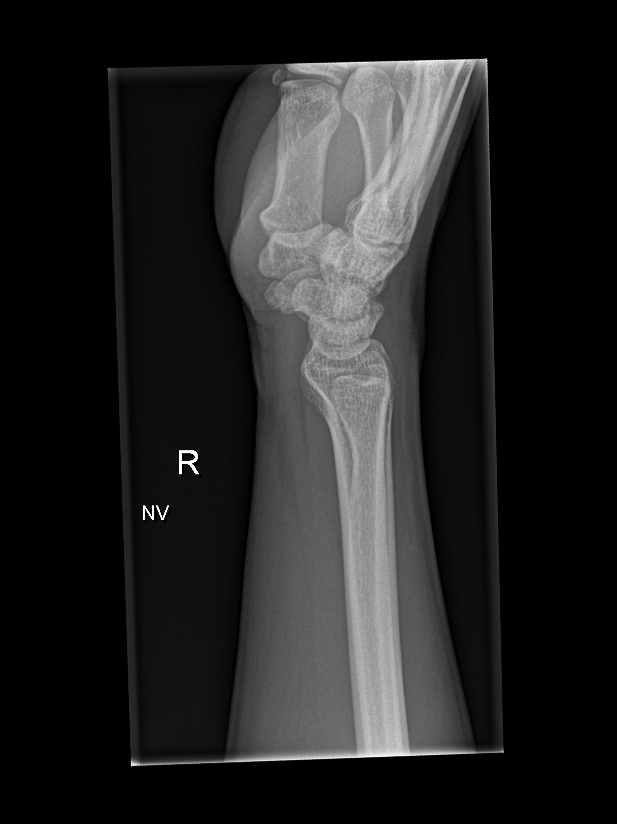 normal wrist xray