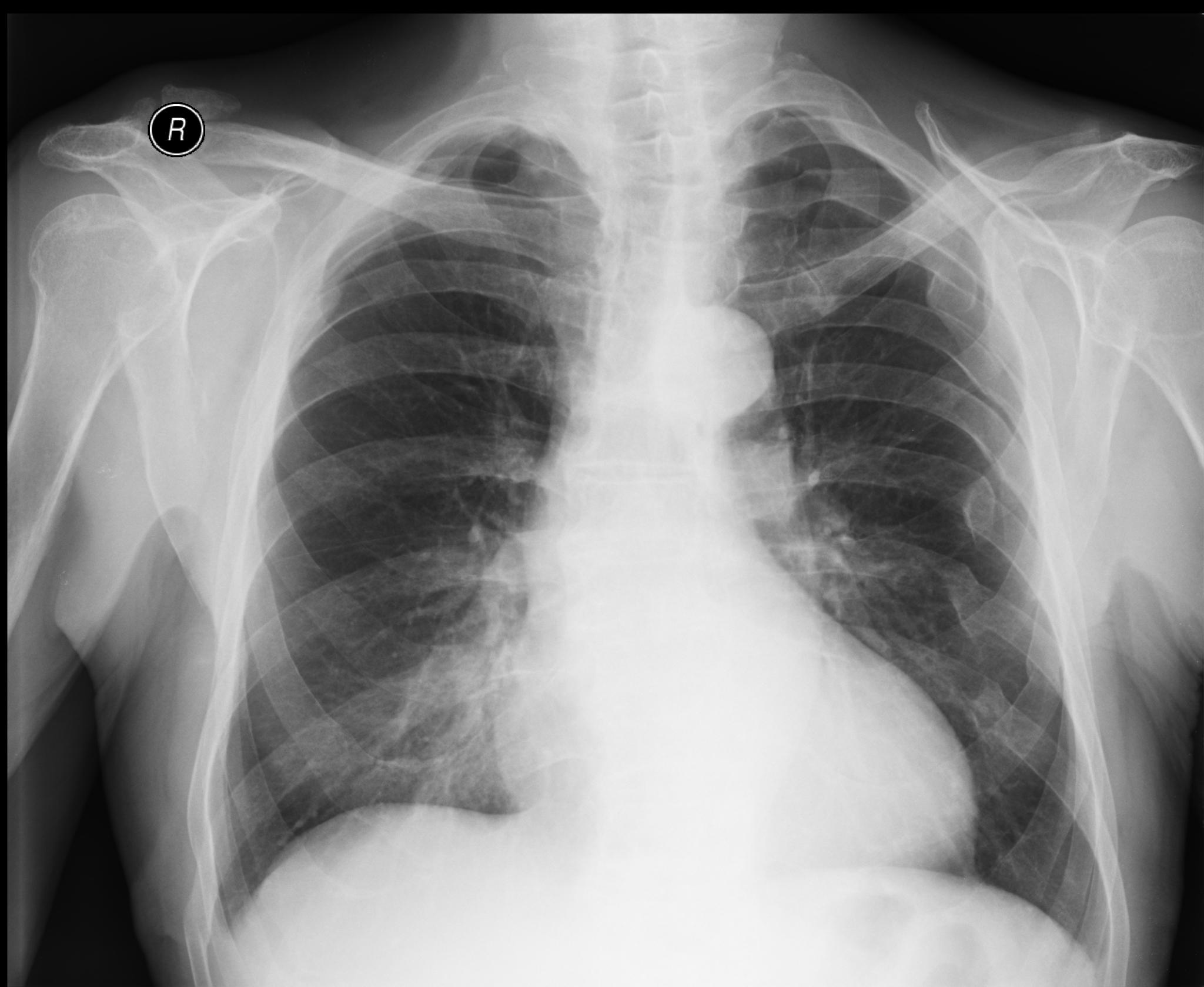 Бронхопневмония. Bronchopneumonia се. Рентгенография бронхопневмонии. Воздушная бронхопневмония.