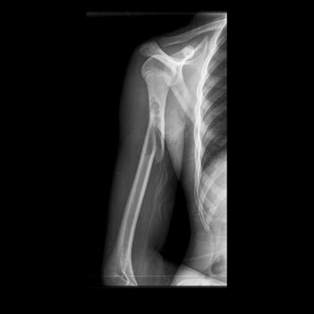 Broken Humerus X Ray