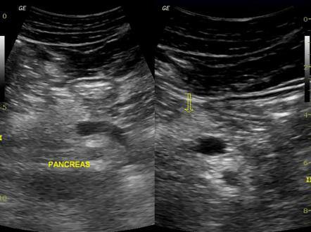 Dorsal pancreatic agenesis | Radiology Case | Radiopaedia.org