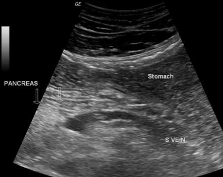 Dorsal pancreatic agenesis | Radiology Reference Article | Radiopaedia.org