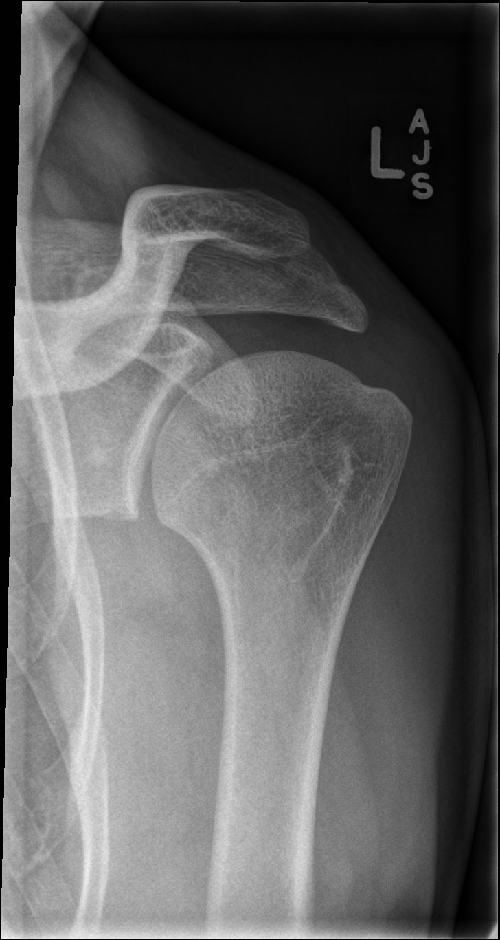 Normal shoulder radiographs | Image | Radiopaedia.org