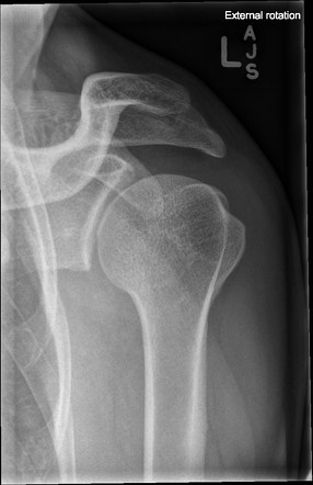 Normal shoulder radiographs | Image | Radiopaedia.org