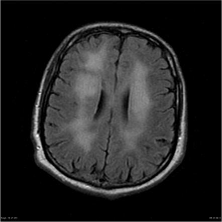 HIV-associated dementia | Radiology Reference Article | Radiopaedia.org