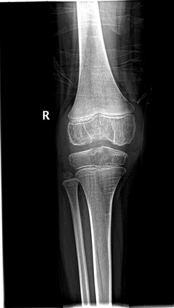 Haemophilic arthropathy - knee | Radiology Case | Radiopaedia.org