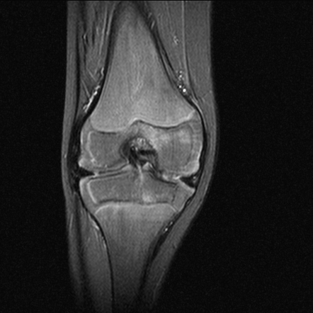 Haemophilic arthropathy | Radiology Reference Article | Radiopaedia.org