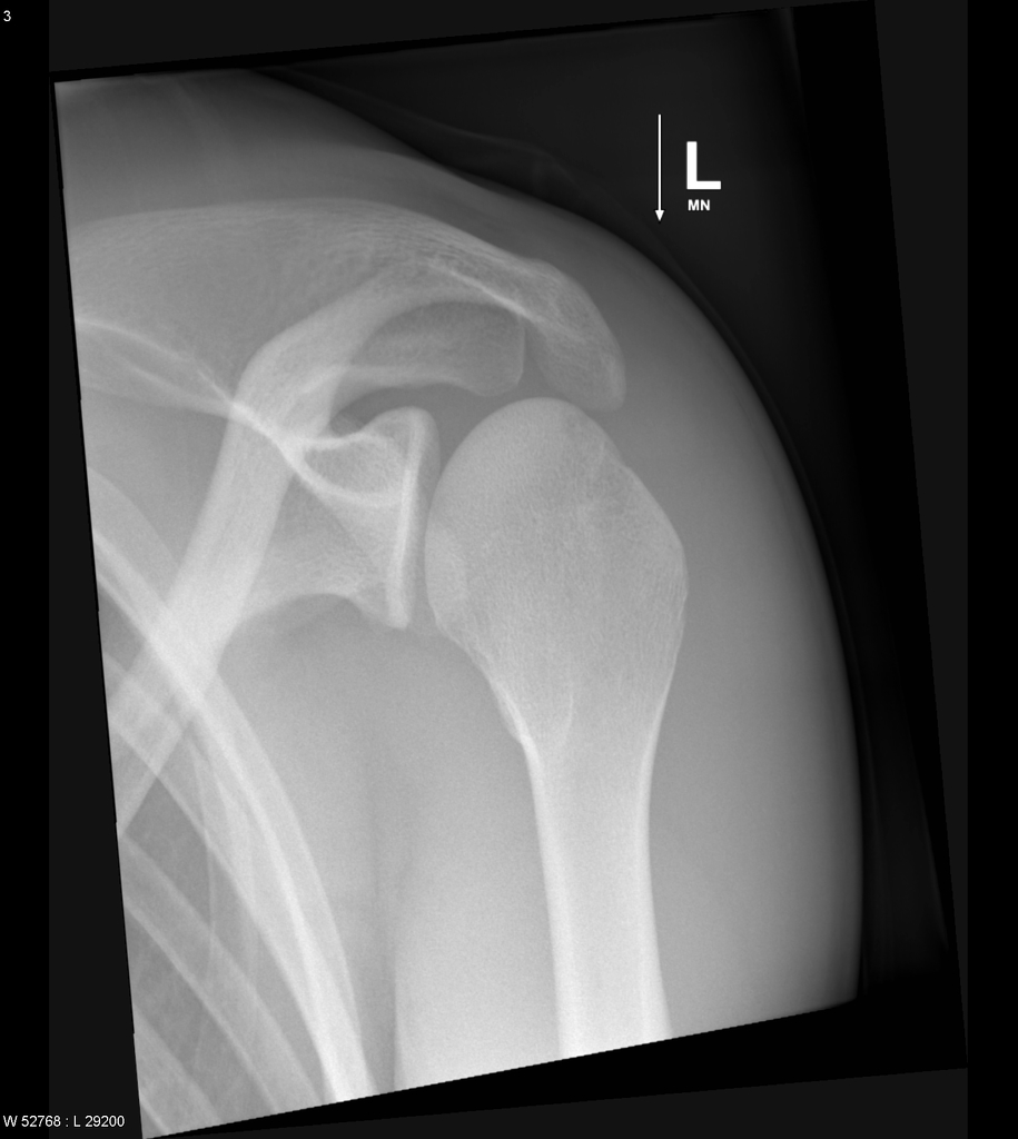 Radiopaedia.org Normal | Garth shoulder: Case | view Radiology