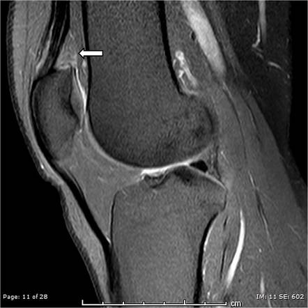 Quadriceps Fat Pad Impingement Syndrome 