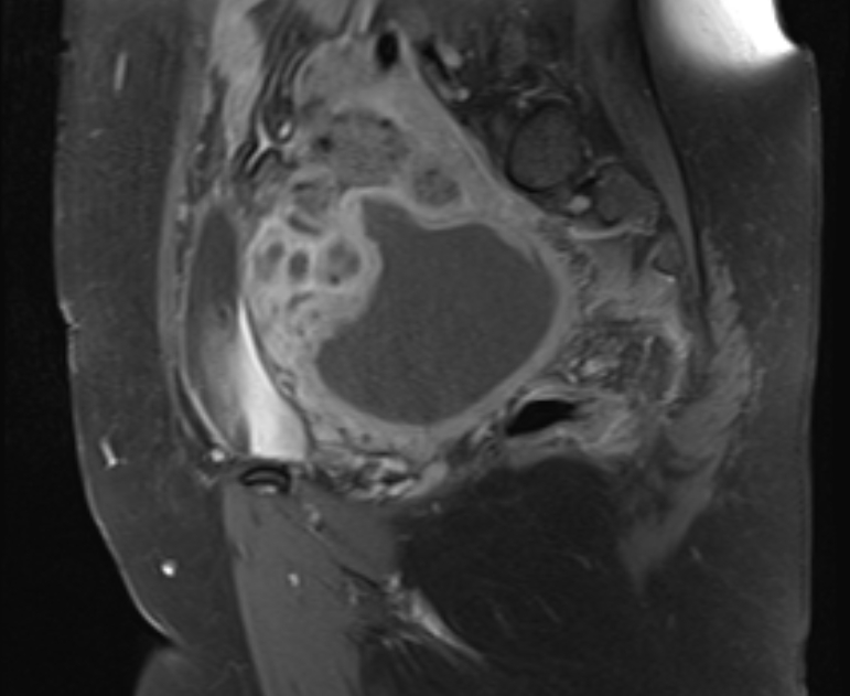 Tubo Ovarian Abscess Image