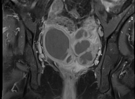 Tubo-ovarian abscess | Image | Radiopaedia.org