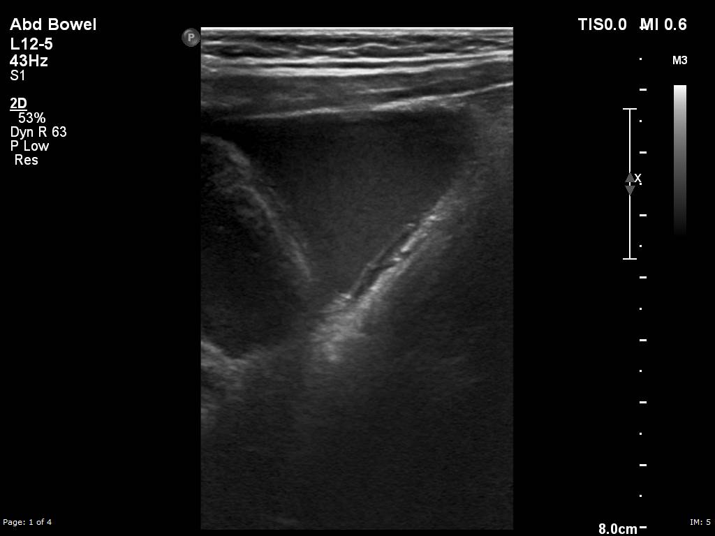 Acute Appendicitis | Image | Radiopaedia.org