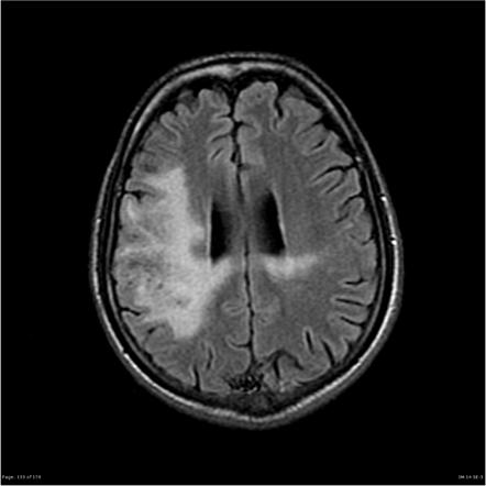 AIDS-defining illness | Radiology Reference Article | Radiopaedia.org