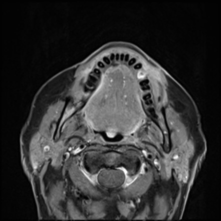 Mantle B Cell Lymphoma | Radiology Case | Radiopaedia.org