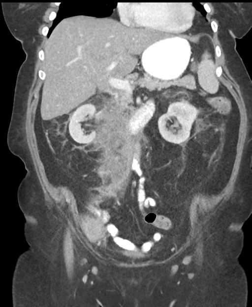 Mantle B Cell Lymphoma | Image | Radiopaedia.org