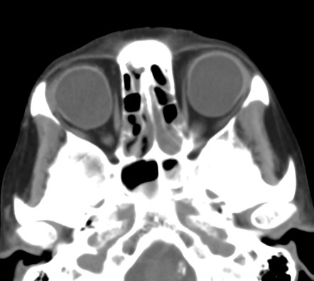 Staphyloma | Image | Radiopaedia.org