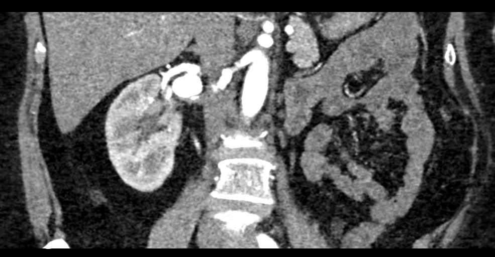 Fibromuscular Dysplasia Involving Renal Arteries With Aneurysm