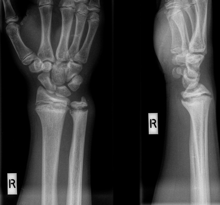 Gymnast wrist | Radiology Reference Article | Radiopaedia.org