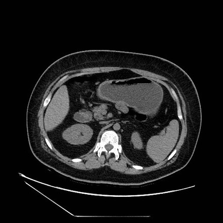 Agenesis of dorsal pancreas | Radiology Case | Radiopaedia.org