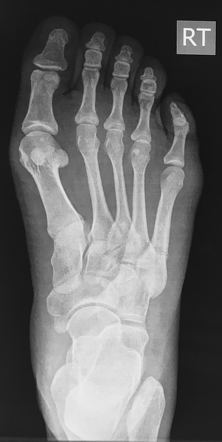 Fracture base of 5th metatarsal | Radiology Case | Radiopaedia.org