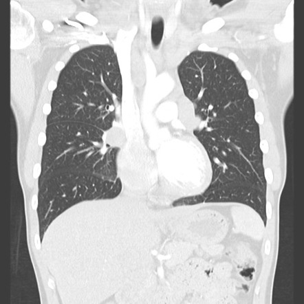 Sarcoidosis | Image | Radiopaedia.org