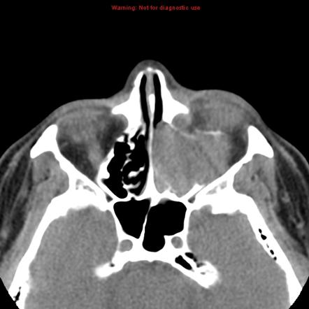 Pleomorphic adenocarcinoma | Image | Radiopaedia.org