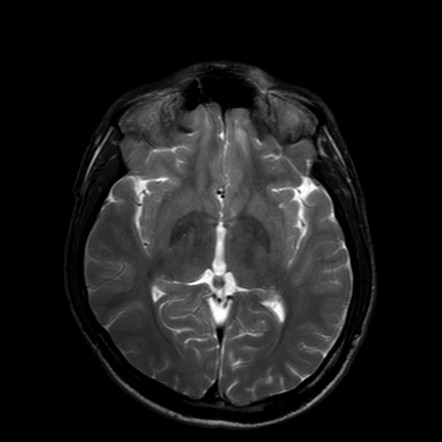 Mesial temporal sclerosis | Image | Radiopaedia.org