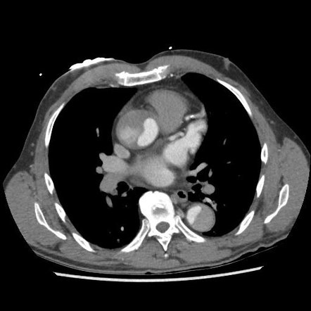 Type A aortic dissection | Radiology Case | Radiopaedia.org