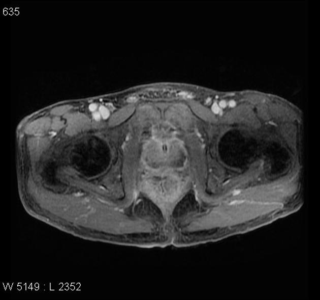 fibroepithelial papilloma meaning paraziti hrana