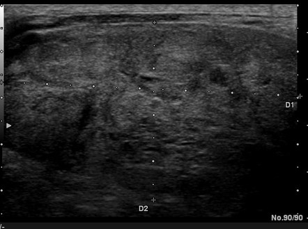 Multinodular goiter | Image | Radiopaedia.org