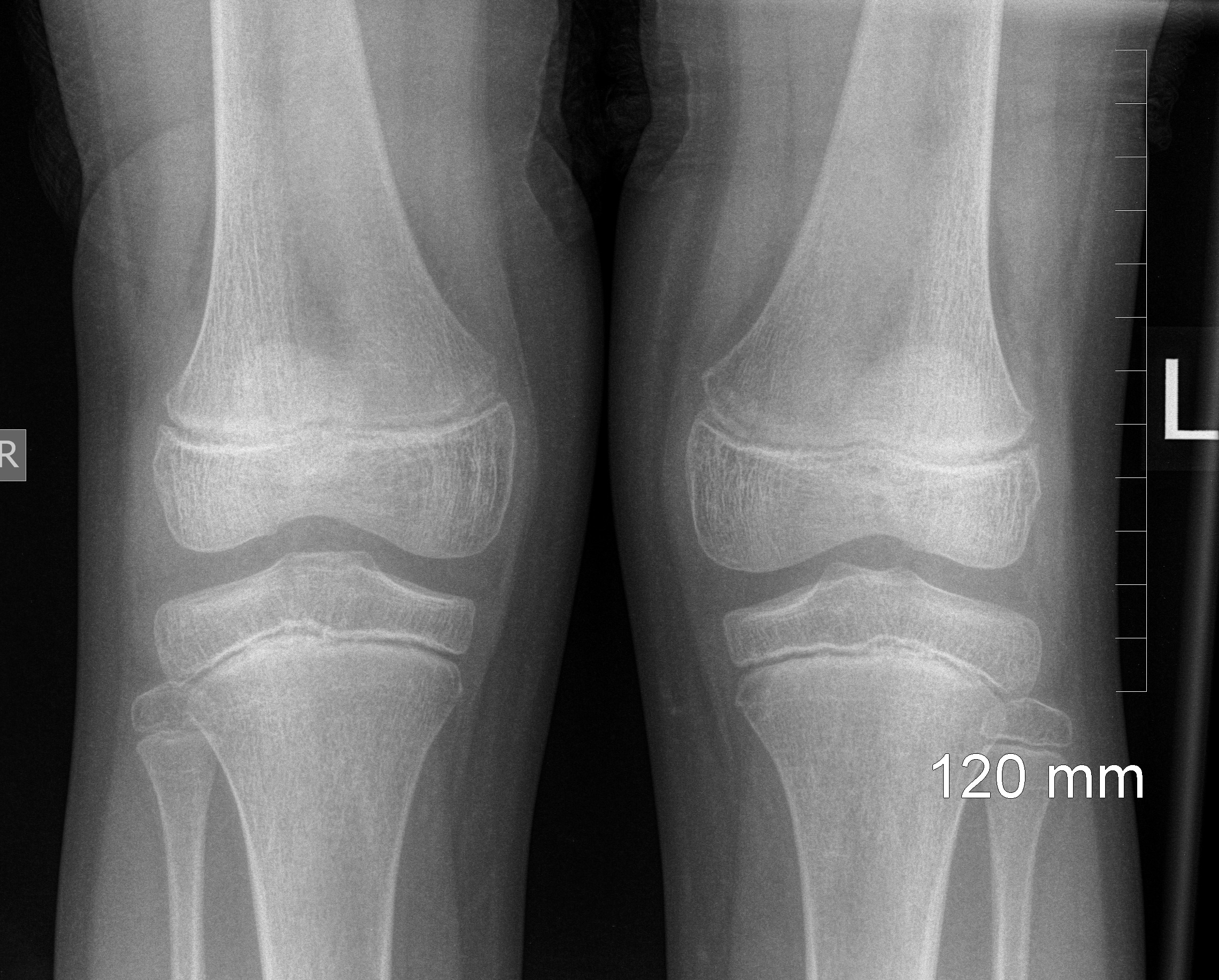 Modality: X-ray (Frontal) .