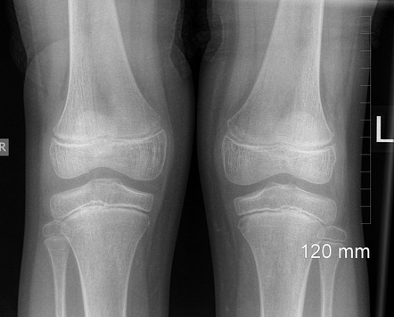 Normal knee x-rays (9-year-old) | Radiology Case | Radiopaedia.org