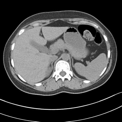 Pancreatic Neuroendocrine Tumor 