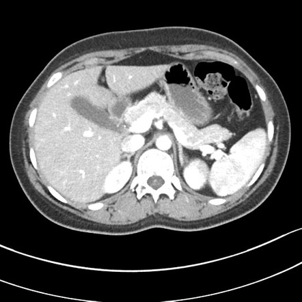 Pancreatic neuroendocrine tumor | Image | Radiopaedia.org