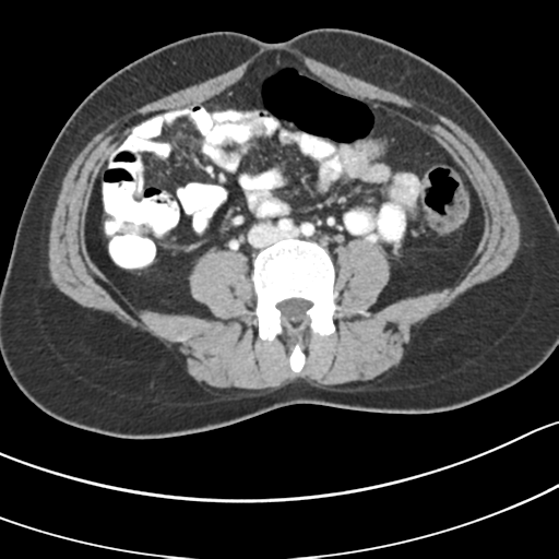 Pancreatic Neuroendocrine Tumor Image Radiopaedia Org