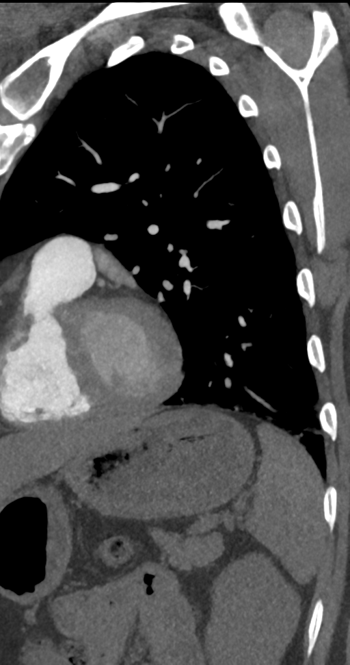 Pulmonary Embolus And Infarct Image