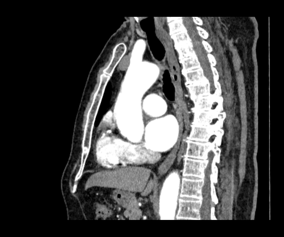 Diaphragmatic eventration | Image | Radiopaedia.org