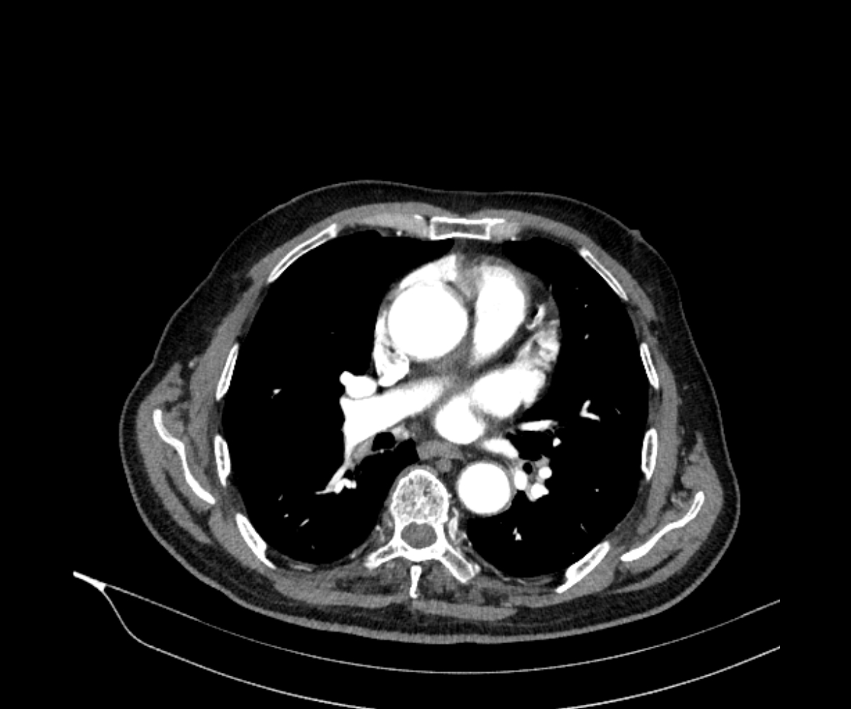 Diaphragmatic eventration | Image | Radiopaedia.org