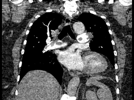 Saddle pulmonary embolism | Image | Radiopaedia.org