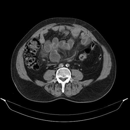 Internal hernia | Radiology Reference Article | Radiopaedia.org