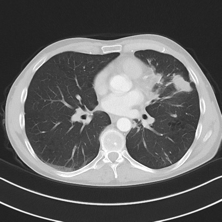 Pulmonary cryptococcosis | Image | Radiopaedia.org